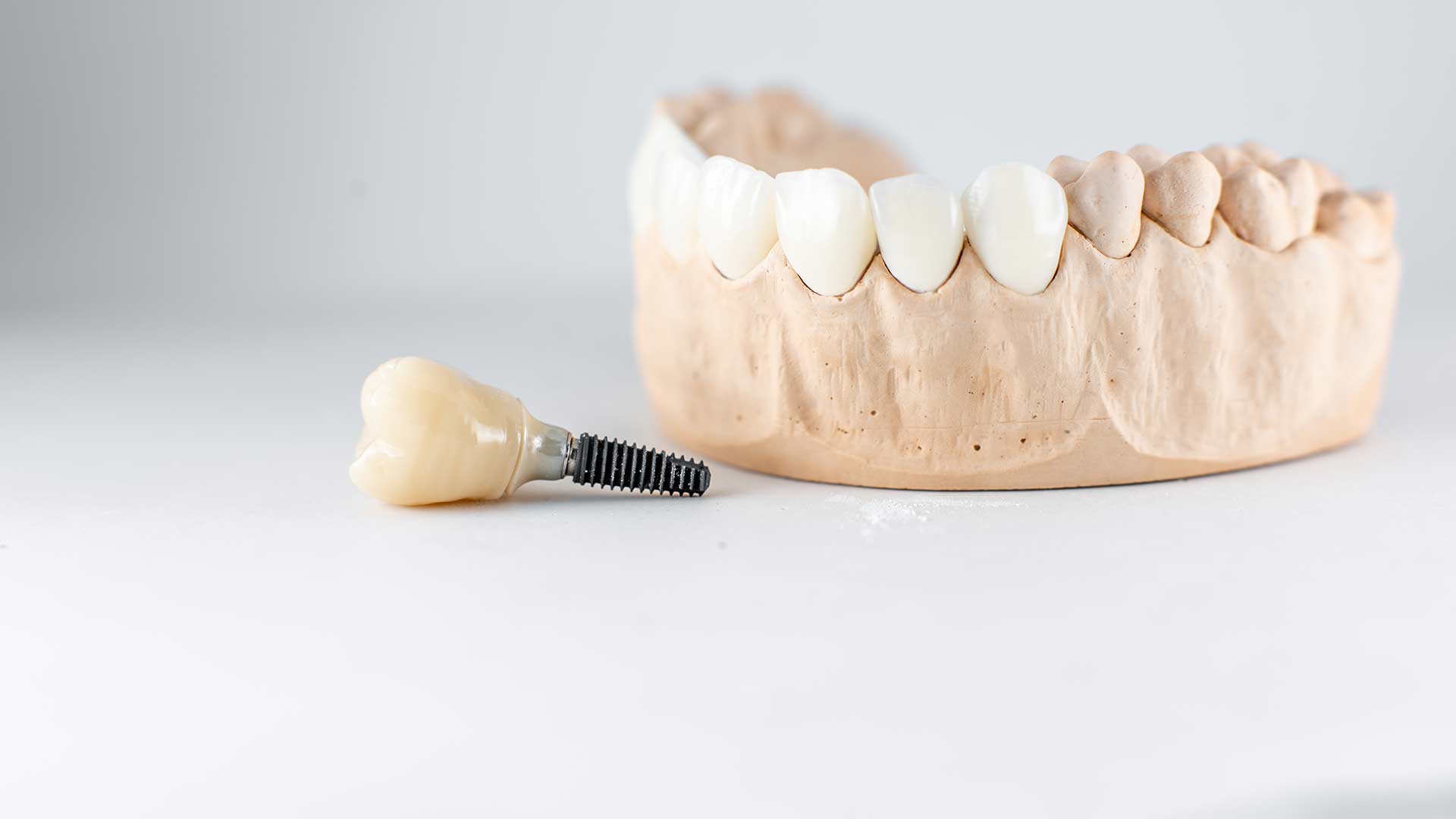 Revive Your Bite with Advanced Dental Implants: No More Gaps or Loose Dentures!