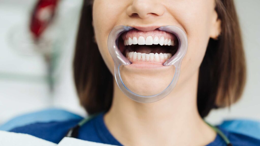 Local Smile Makeovers: Skip the Trip and Trust Hillcrest Dental in North Devon